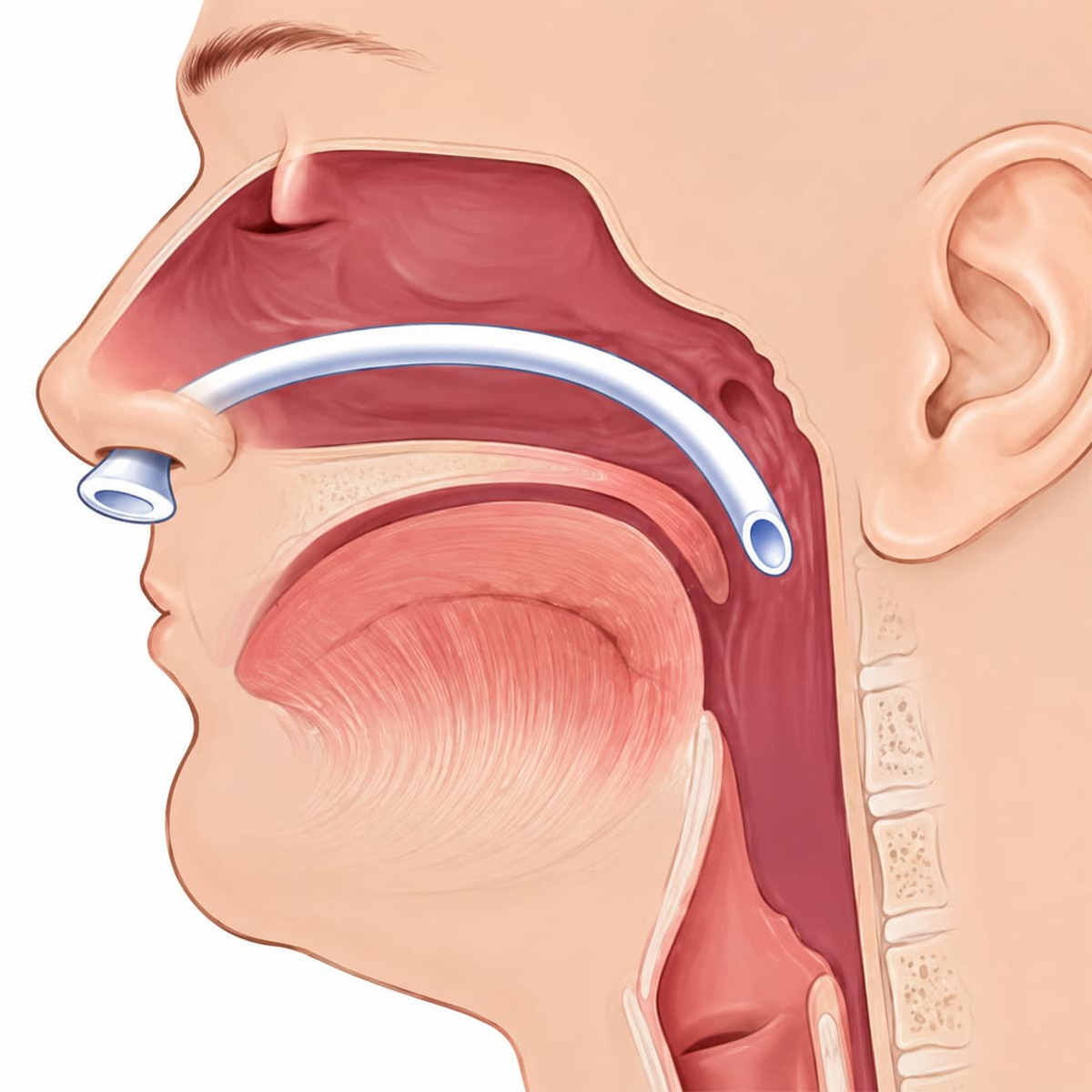 Medical illustration showing how a nasopharyngeal airway works 